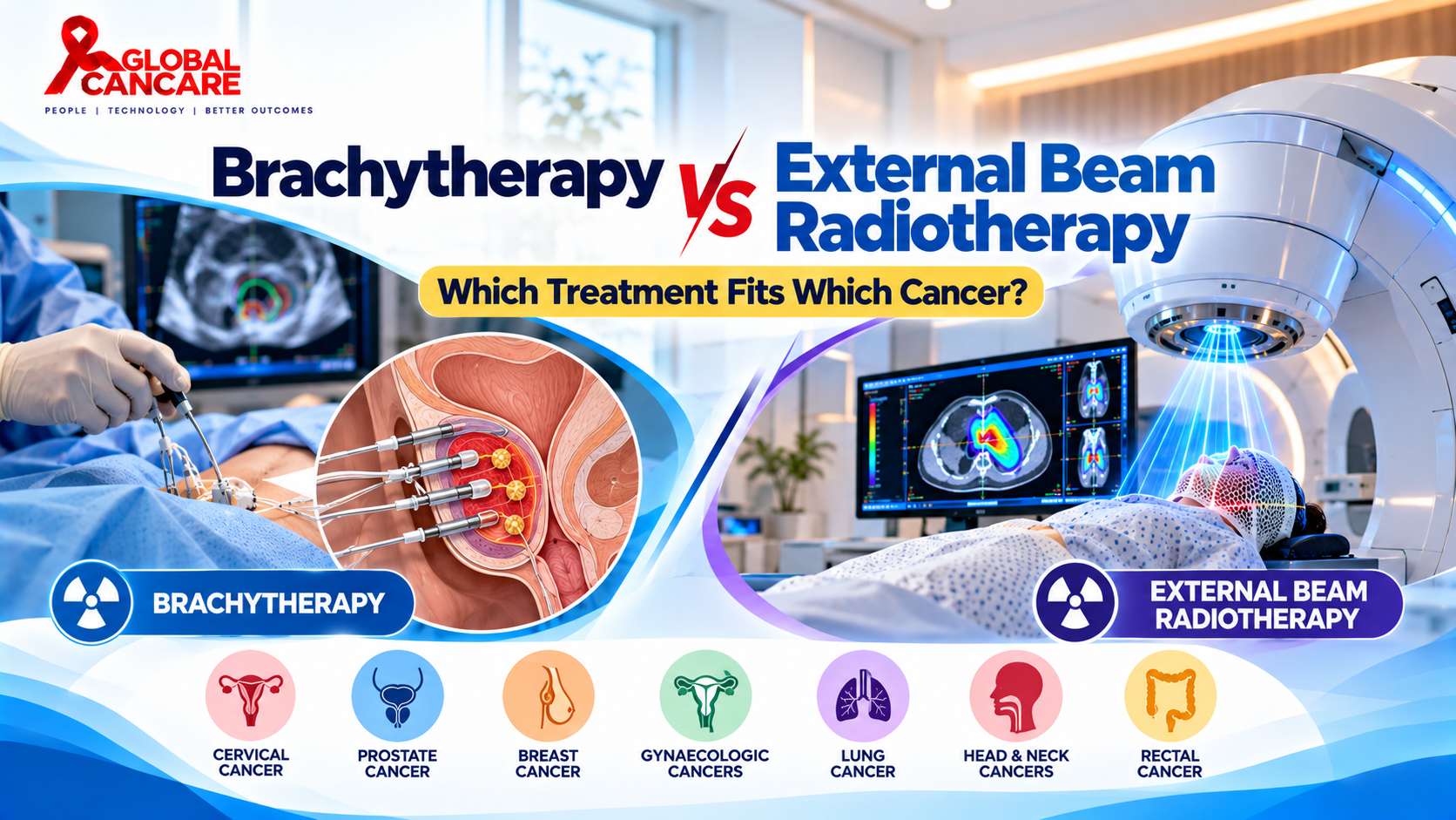 Brachytherapy vs External Beam Radiotherapy.png