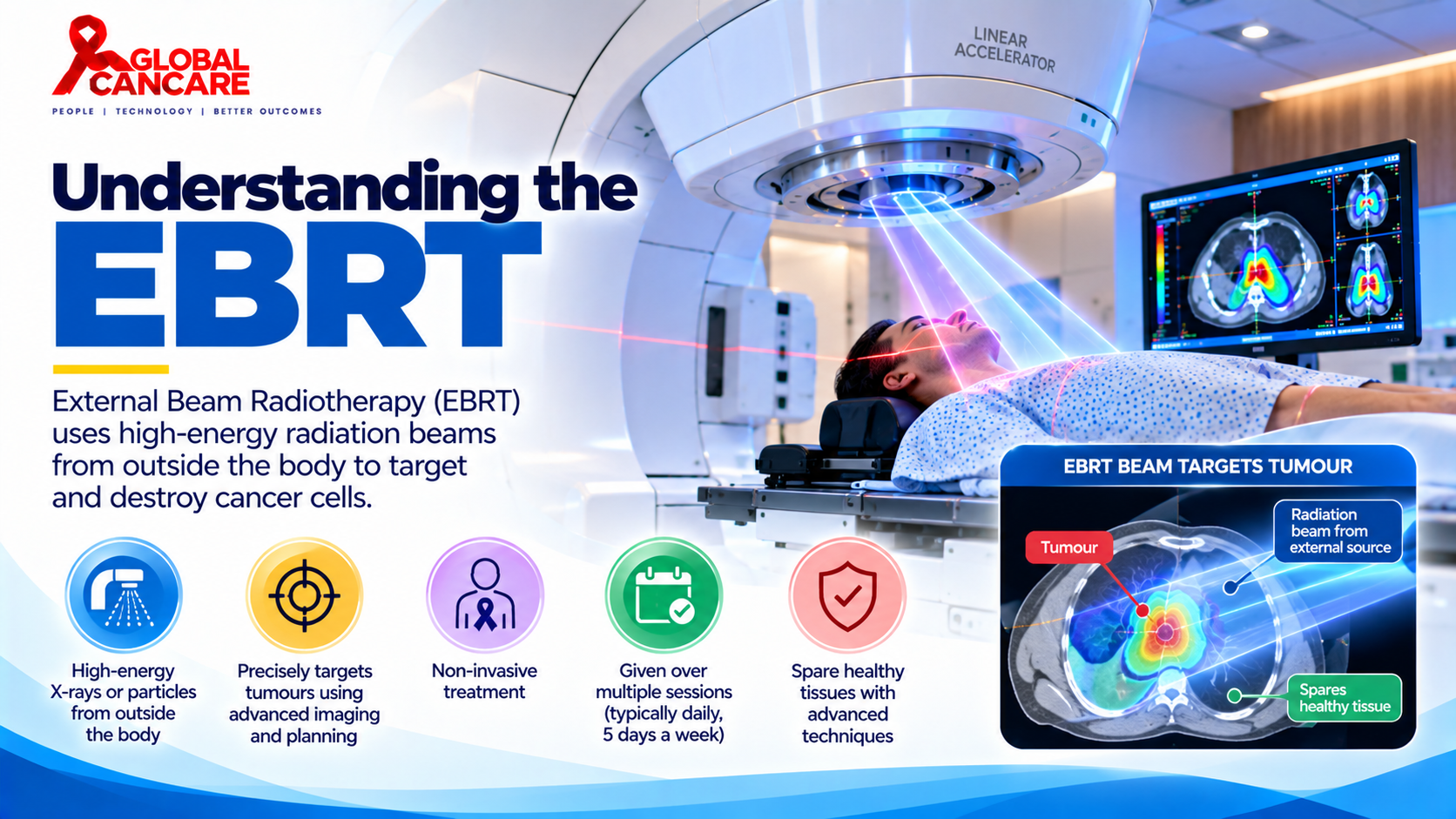 Understanding EBRT_ Precision Cancer Treatment.png