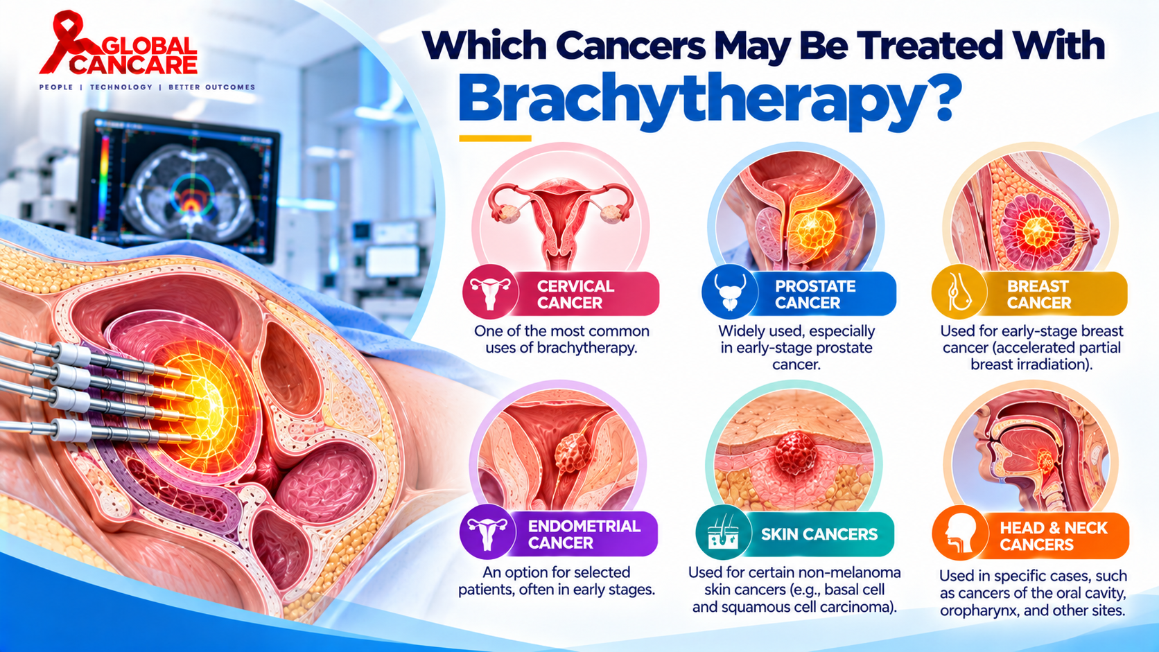Brachytherapy Cancer Treatment Infographic.png