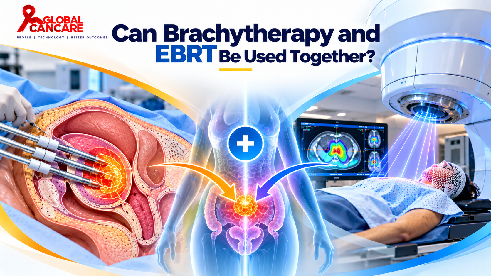 Combining Brachytherapy and EBRT.png